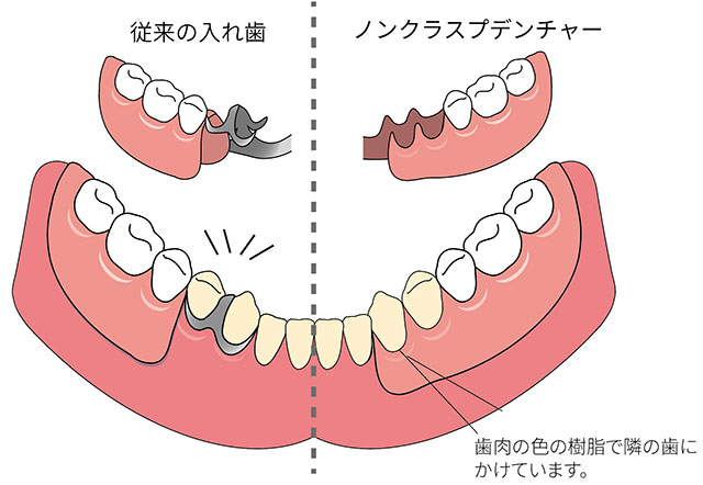宝塚市の歯医者、宝塚南口駅から徒歩2分の笹山歯科医院の入れ歯